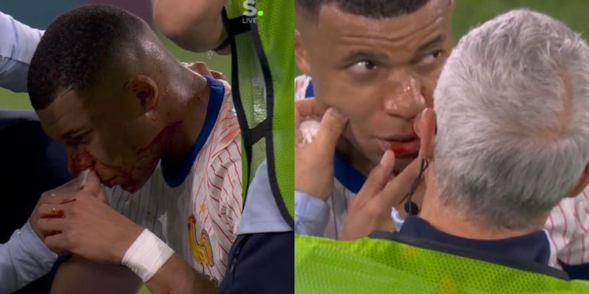Le rompieron nariz a Mbappé durante partido ante Austria