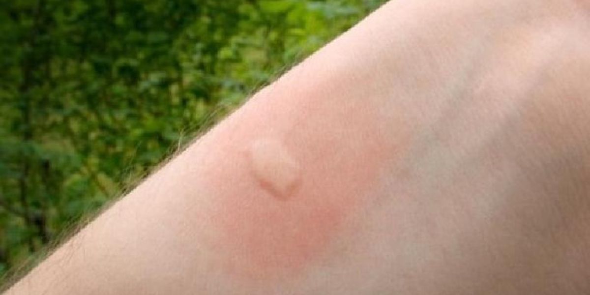 ¿Por qué te pican más los mosquitos que a otros? Revelan razón