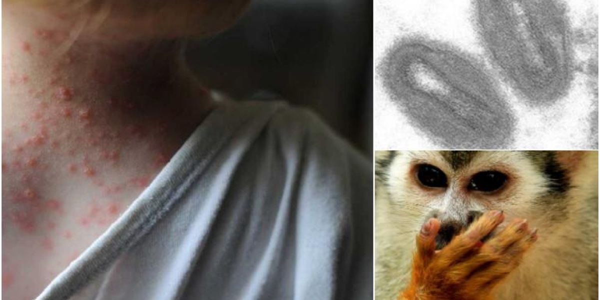 Viruela del mono: Qué es, cómo se contagia y cuáles son sus síntomas