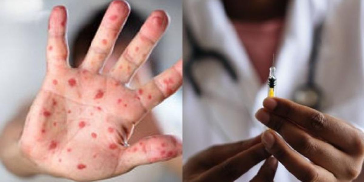 Vacunará España a casos sospechosos de viruela del mono