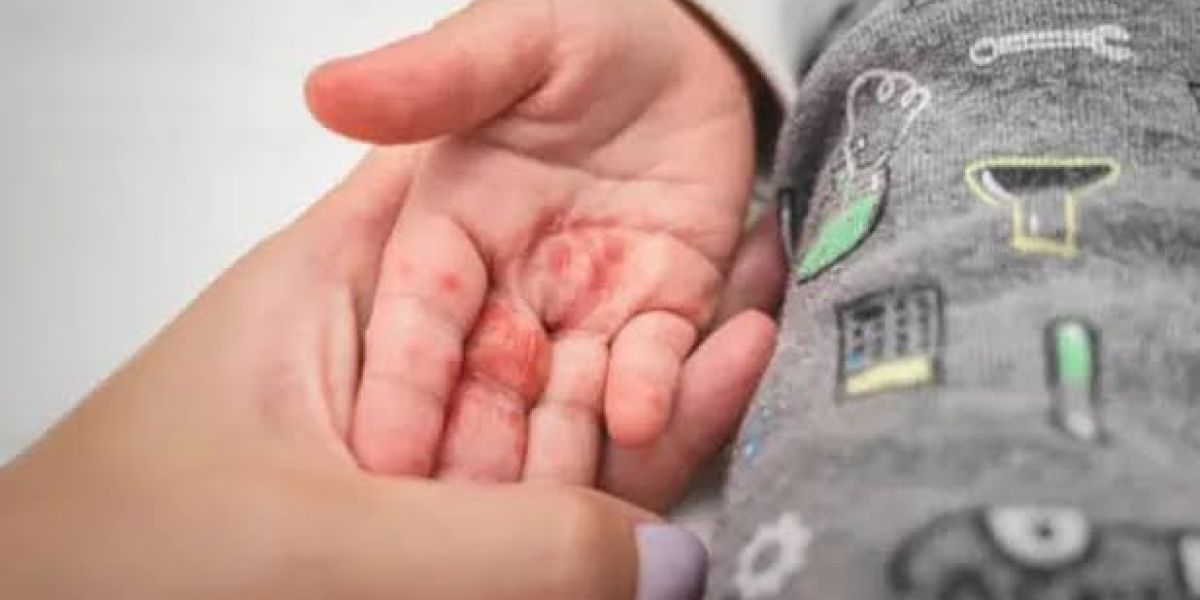 No se justifica el cierre prolongado de guarderías por casos de “manos, pies y boca”: Secretaría de Salud