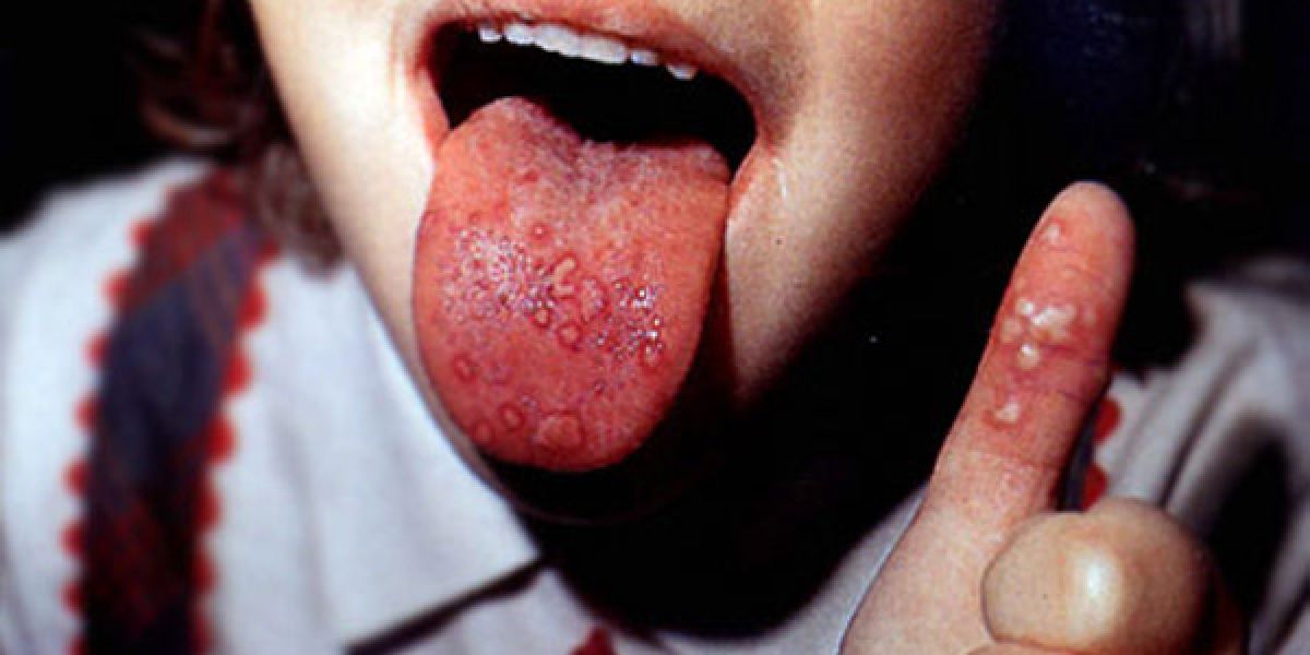 Alerta por un nuevo virus: Niños, los más afectados