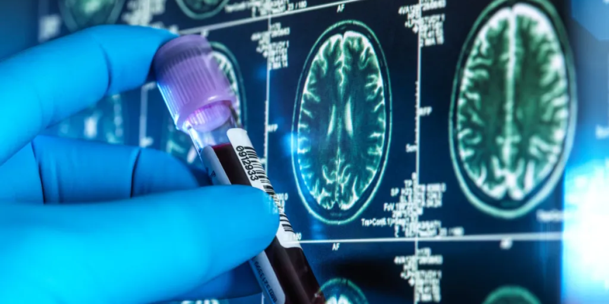 Nuevo test sanguíneo aprobado por la FDA para detectar Alzheimer