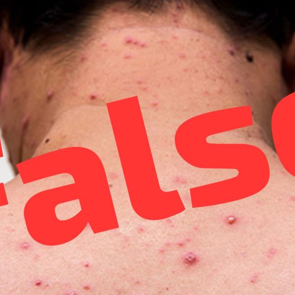 Escuela de Reynosa reporta caso de sarampión; Secretaria de Salud lo descarta