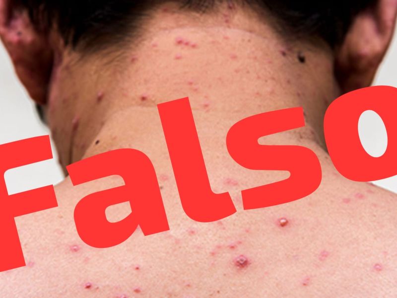 Escuela de Reynosa reporta caso de sarampión; Secretaria de Salud lo descarta