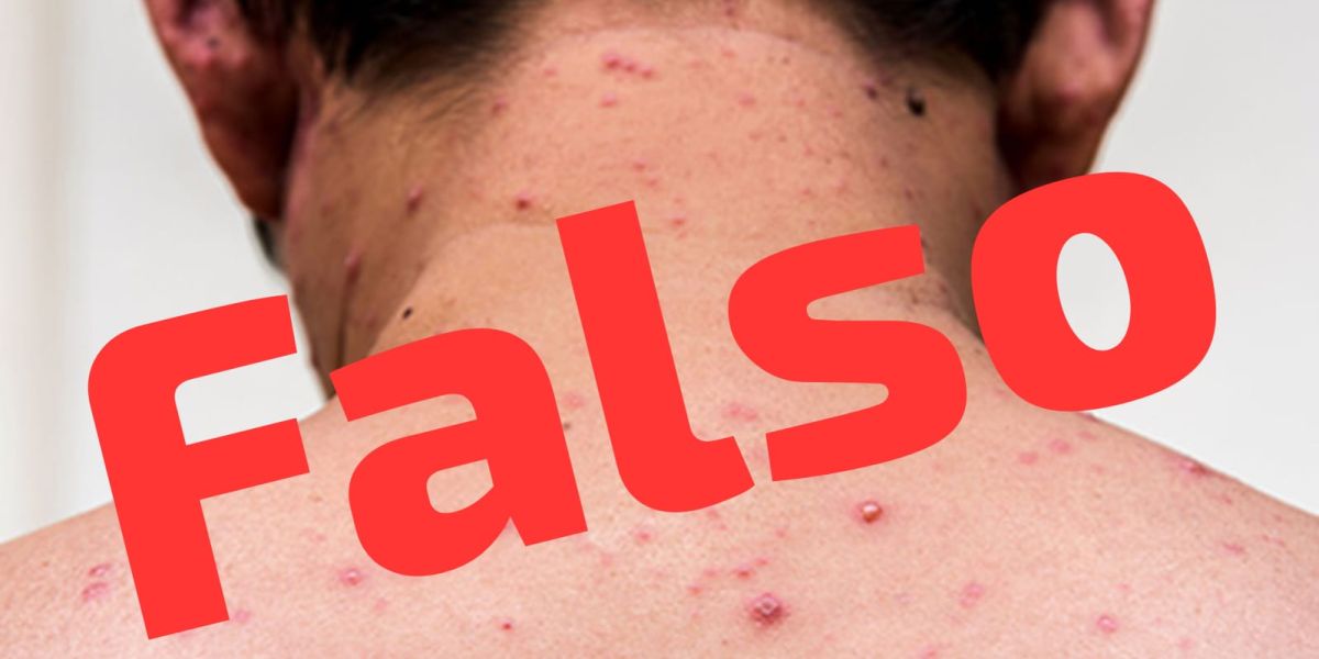 Escuela de Reynosa reporta caso de sarampión; Secretaria de Salud lo descarta