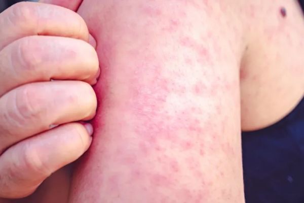 Refuerzan vigilancia sanitaria en comunidades menonitas por sarampión