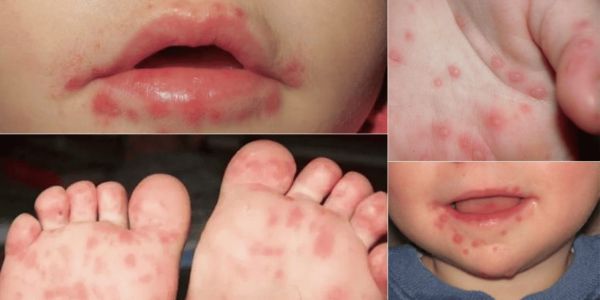 Aumentan los brotes de síndrome mano-pie-boca en guarderías de Tamaulipas