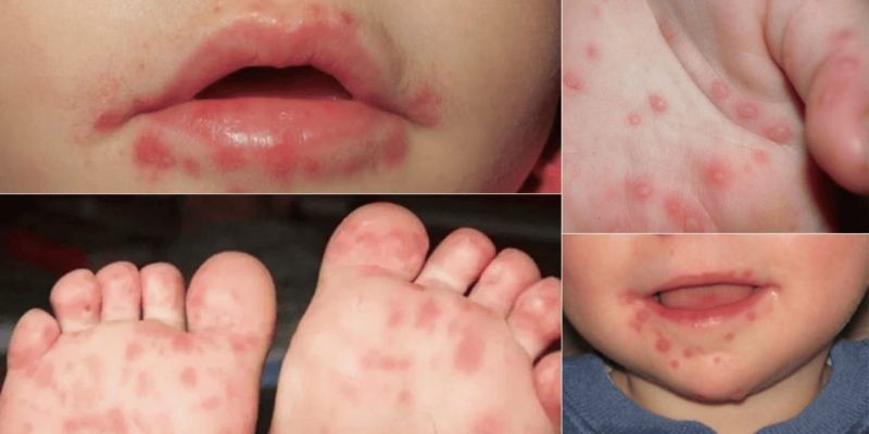 Aumentan los brotes de síndrome mano-pie-boca en guarderías de Tamaulipas
