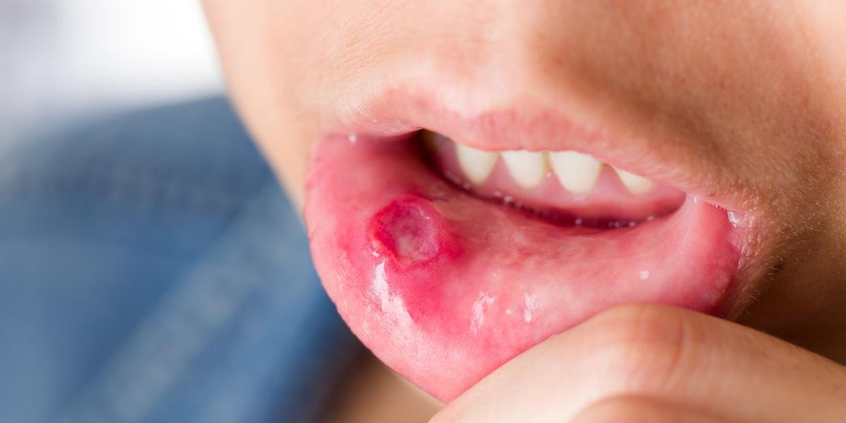 Se expande el virus Coxsackie a primarias; hasta los adultos pueden contagiarse