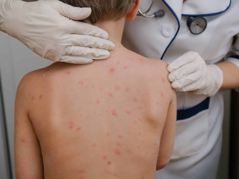 Detectan en Ciudad Madero caso probable de sarampión en menor