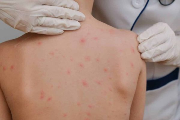 Tamaulipas se mantiene libre de sarampión por alta respuesta a la vacunación