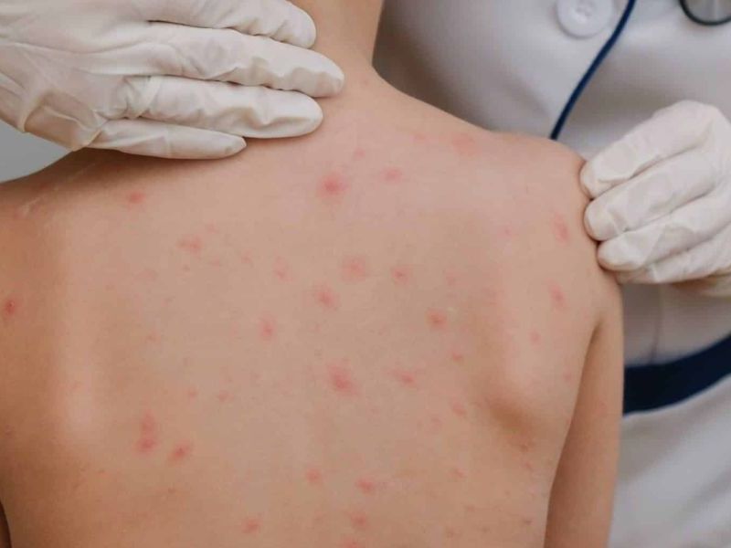 Tamaulipas se mantiene libre de sarampión por alta respuesta a la vacunación