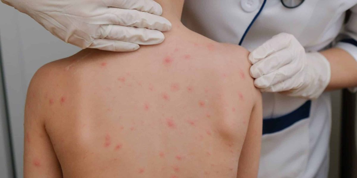 Detectan en Ciudad Madero caso probable de sarampión en menor