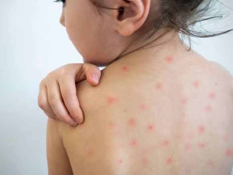 Persiste Tamaulipas como el único estado sin sarampión