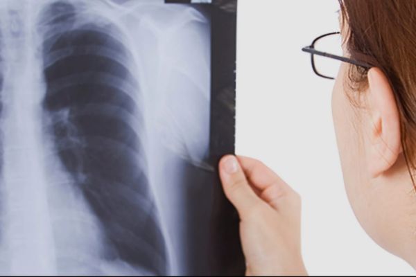 Tuberculosis sigue al alza en Tamaulipas; superan los 400 casos en tres meses