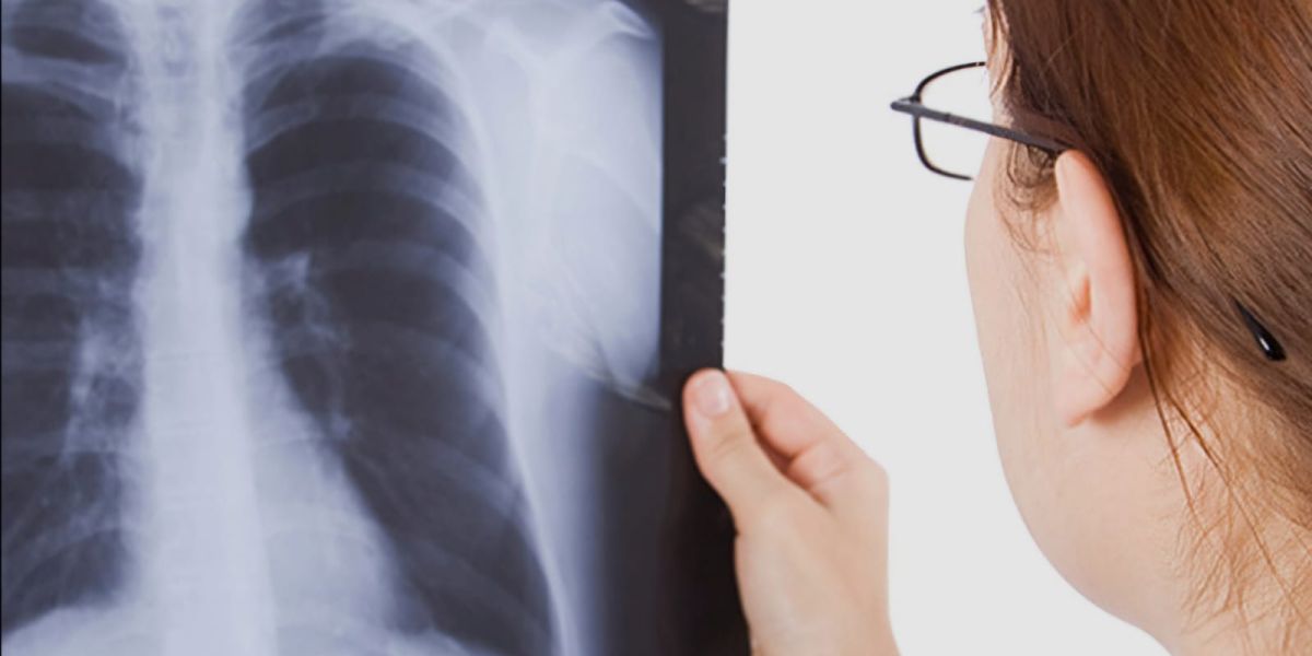 Tuberculosis sigue al alza en Tamaulipas; superan los 400 casos en tres meses