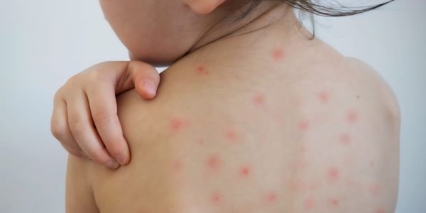 Suben 46% los casos de sarampión en México; Tamaulipas se mantiene libre de la enfermedad