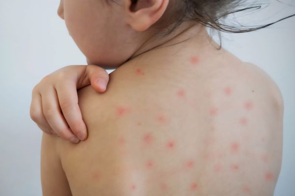 Suben 46% los casos de sarampión en México; Tamaulipas se mantiene libre de la enfermedad