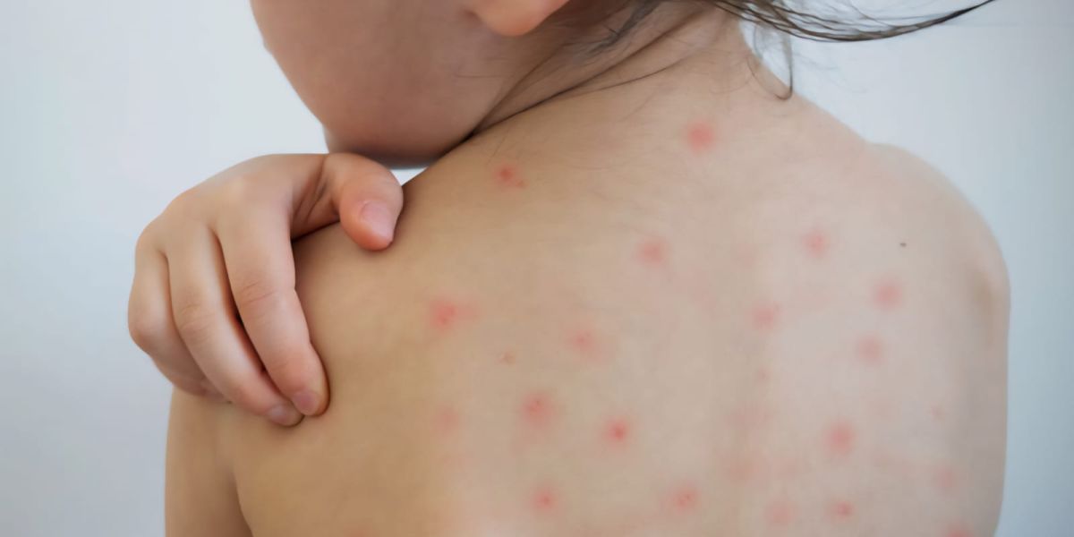 Suben 46% los casos de sarampión en México; Tamaulipas se mantiene libre de la enfermedad