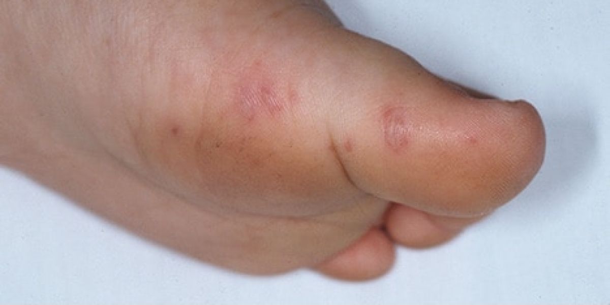 Recomiendan no automedicarse contra el Virus “mano-pie-boca”