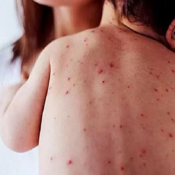 Se disparan contagios de sarampión en México