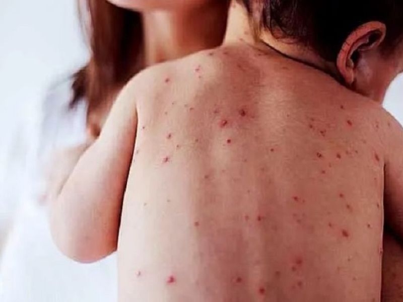 Se disparan contagios de sarampión en México