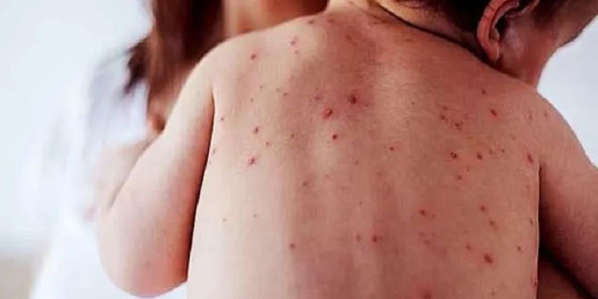 Se disparan contagios de sarampión en México