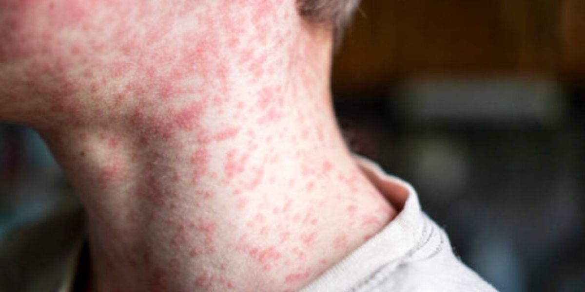 Confirman primer caso de sarampión en Hidalgo